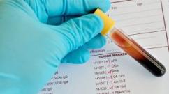 Анализ крови на онкомаркеры: виды онкомаркеров и расшифровка результатов
